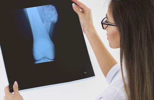 Osteocondroma: você conhece esse tipo de tumor?